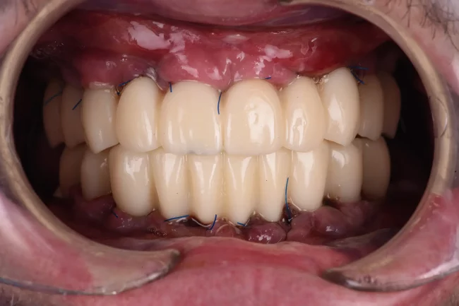 Extracción de todas las piezas, colocación de implantes y provisionales el mismo día 1 Caso Clínico 01 Imagen 03
